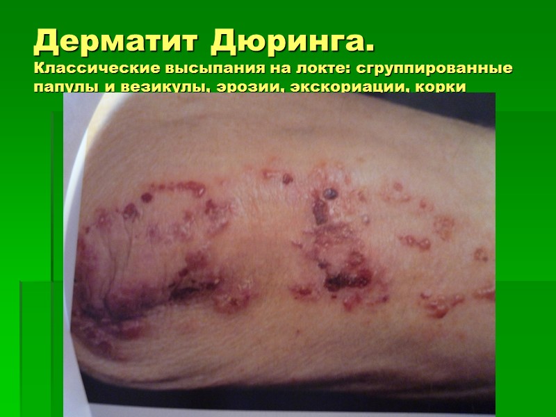 Дерматит Дюринга. Классические высыпания на локте: сгруппированные папулы и везикулы, эрозии, экскориации, корки